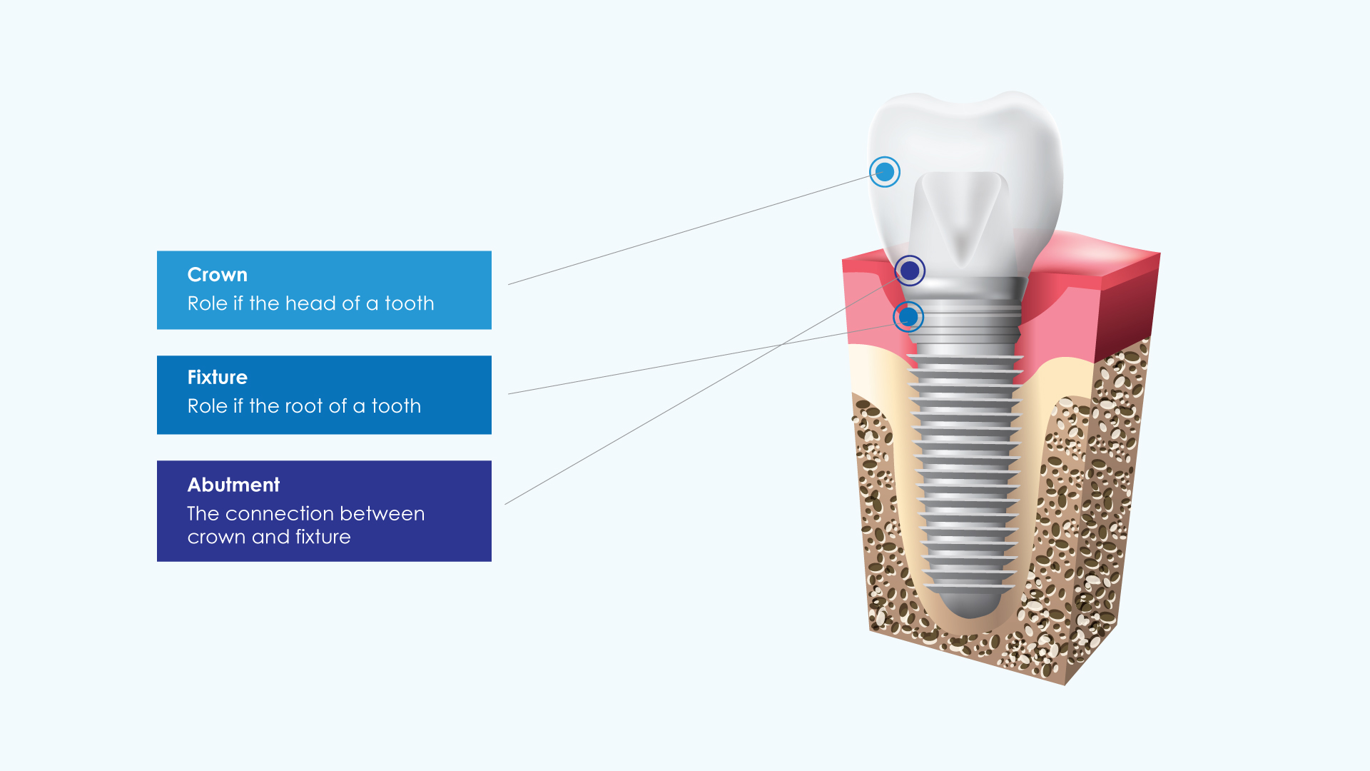 Teeth Implant Treatment Singapore - Family Dental Centre