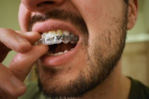 A bearded man is removing his clear dental aligners