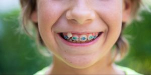 A child is smiling brightly in colourful metal braces