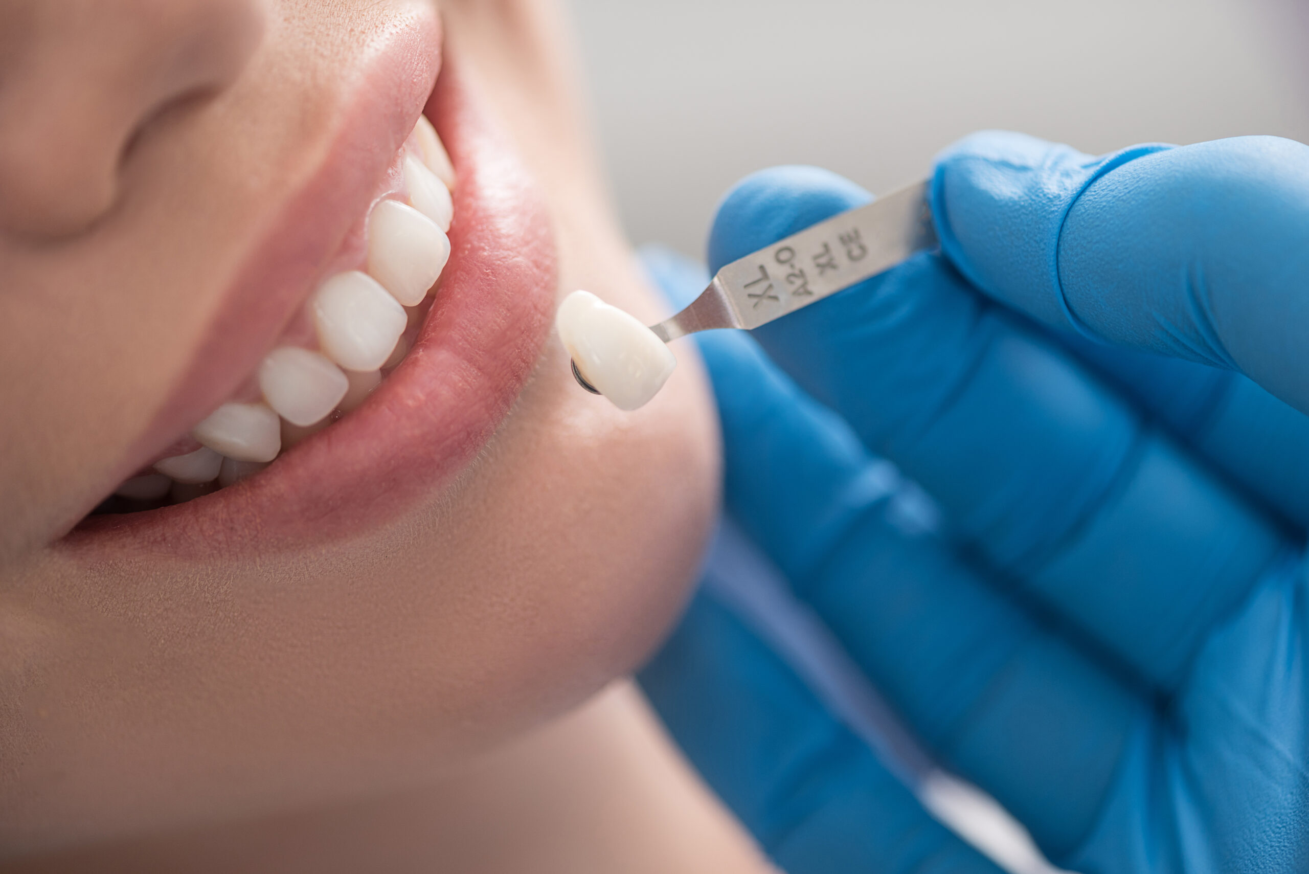 lady being shown a tooth veneer of similar color to her teeth