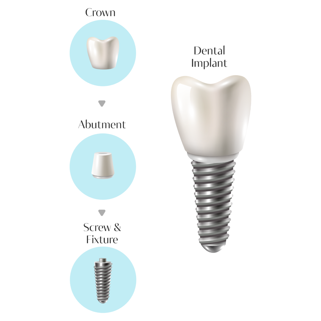 dental_implant_1080x1080