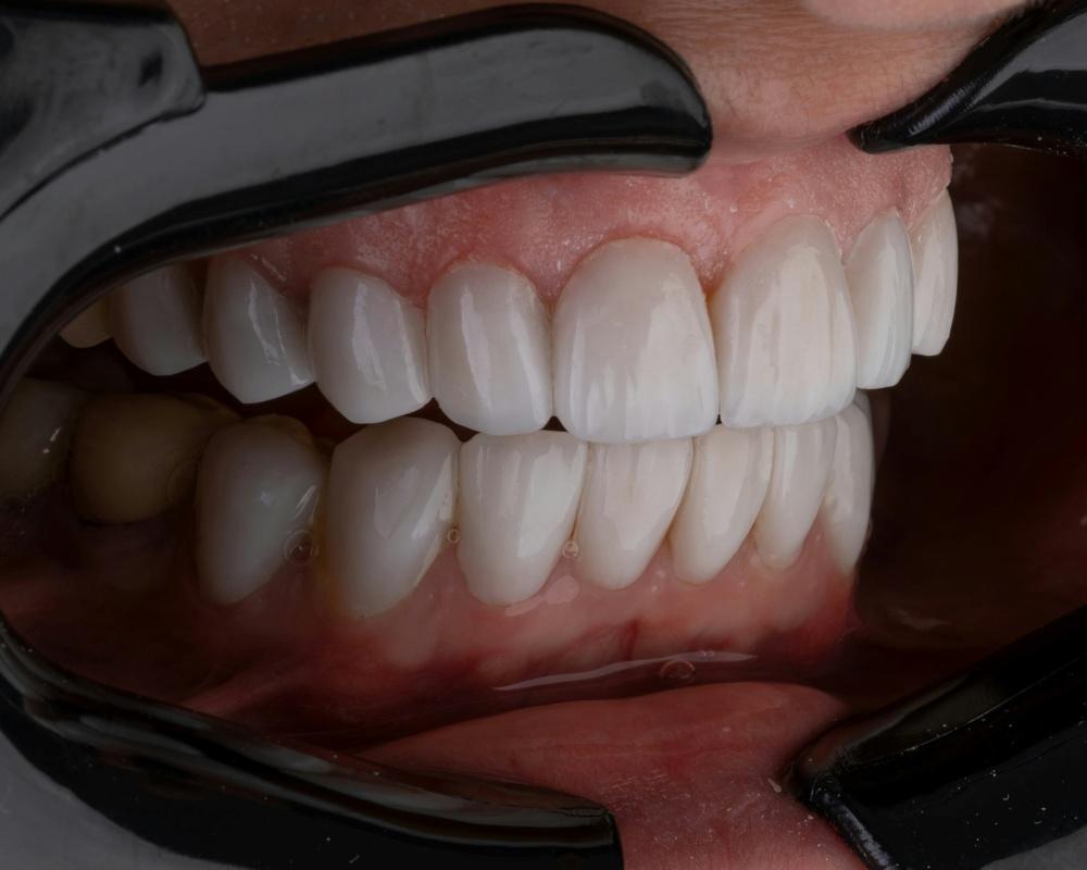 magnified view of clean, white teeth with healthy gums