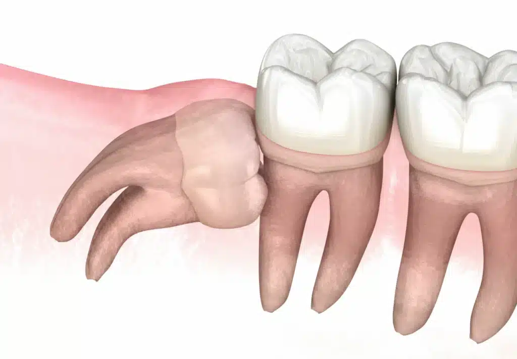 Wisdom tooth misalignment