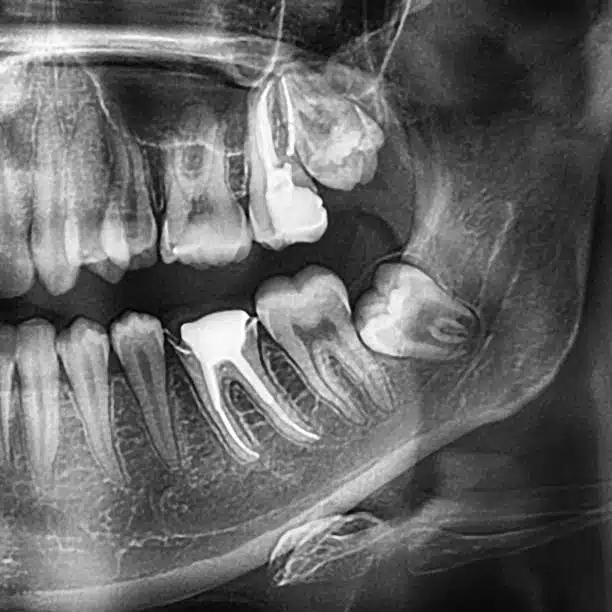 wisdom tooth misalignment x-ray