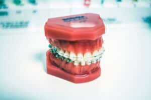 Teeth model with metal braces