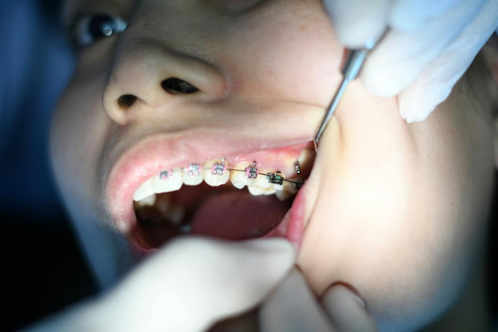 a patient with metal braces having teeth examined