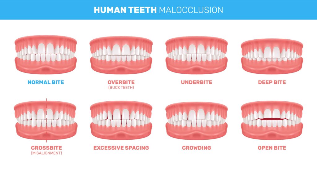 illustration of human teeth malocclusion