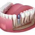 abutment is attached to the implant fixture