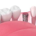 dental implant healing and integration with jawbone