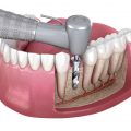 placement of dental implant